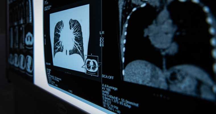 коронавирус Свердловская область компьютерная томография Серов Краснотурьинск